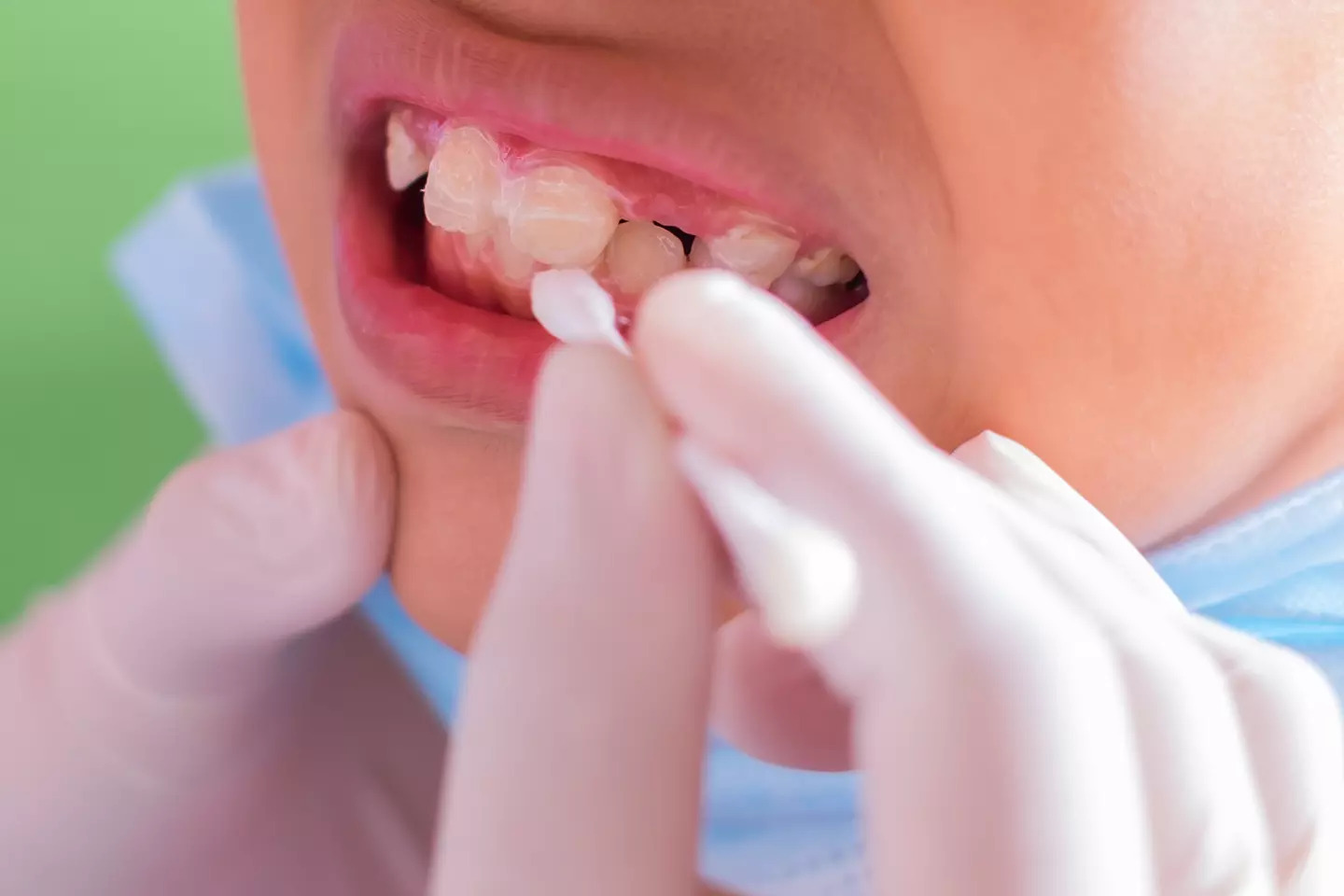 Fluoride Treatment - Dr. Sunit Jain Dental Care