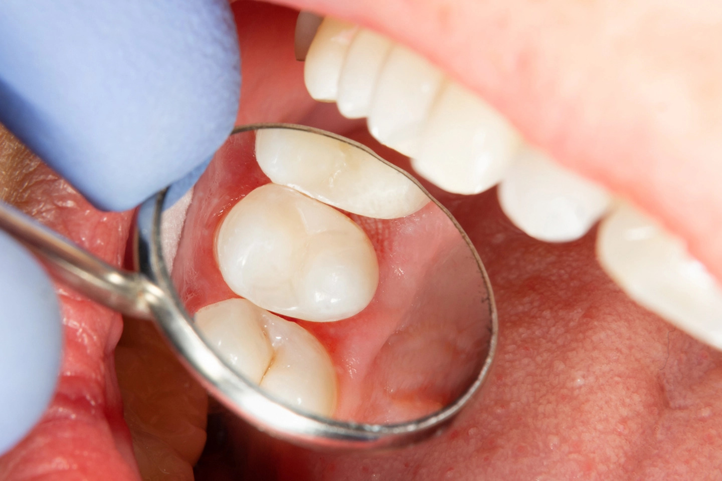 Sealants - Dr. Sunit Jain Dental Care
