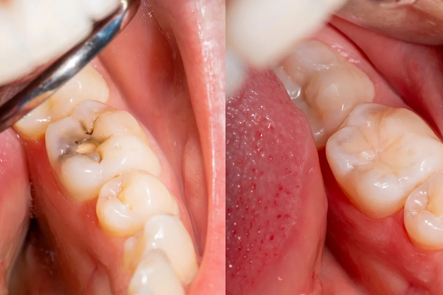 Silver Diamine Fluoride - Dr. Sunit Jain Dental Care