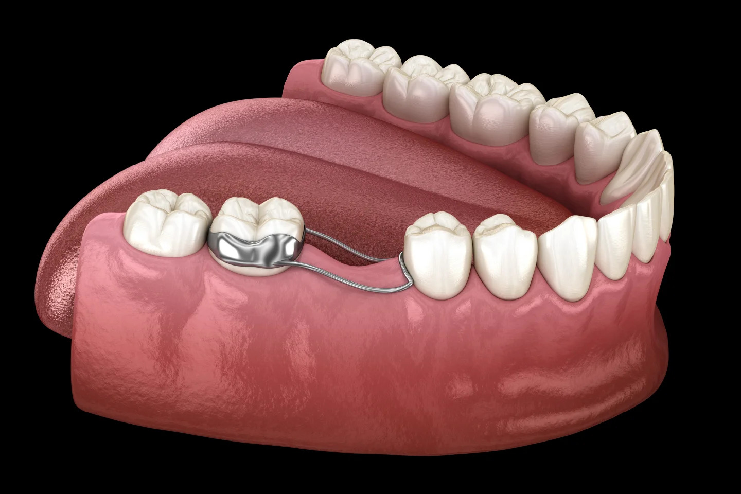 Space Maintainer at Dr. Sunit Jain Dental Care