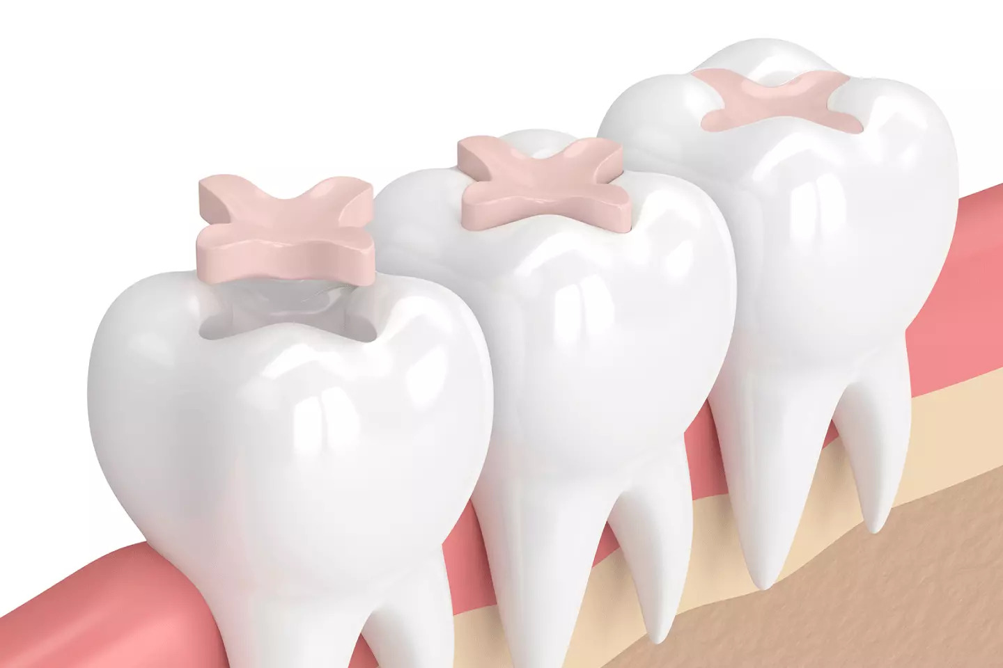 Tooth Fillings - Dr. Sunit Jain Dental Care