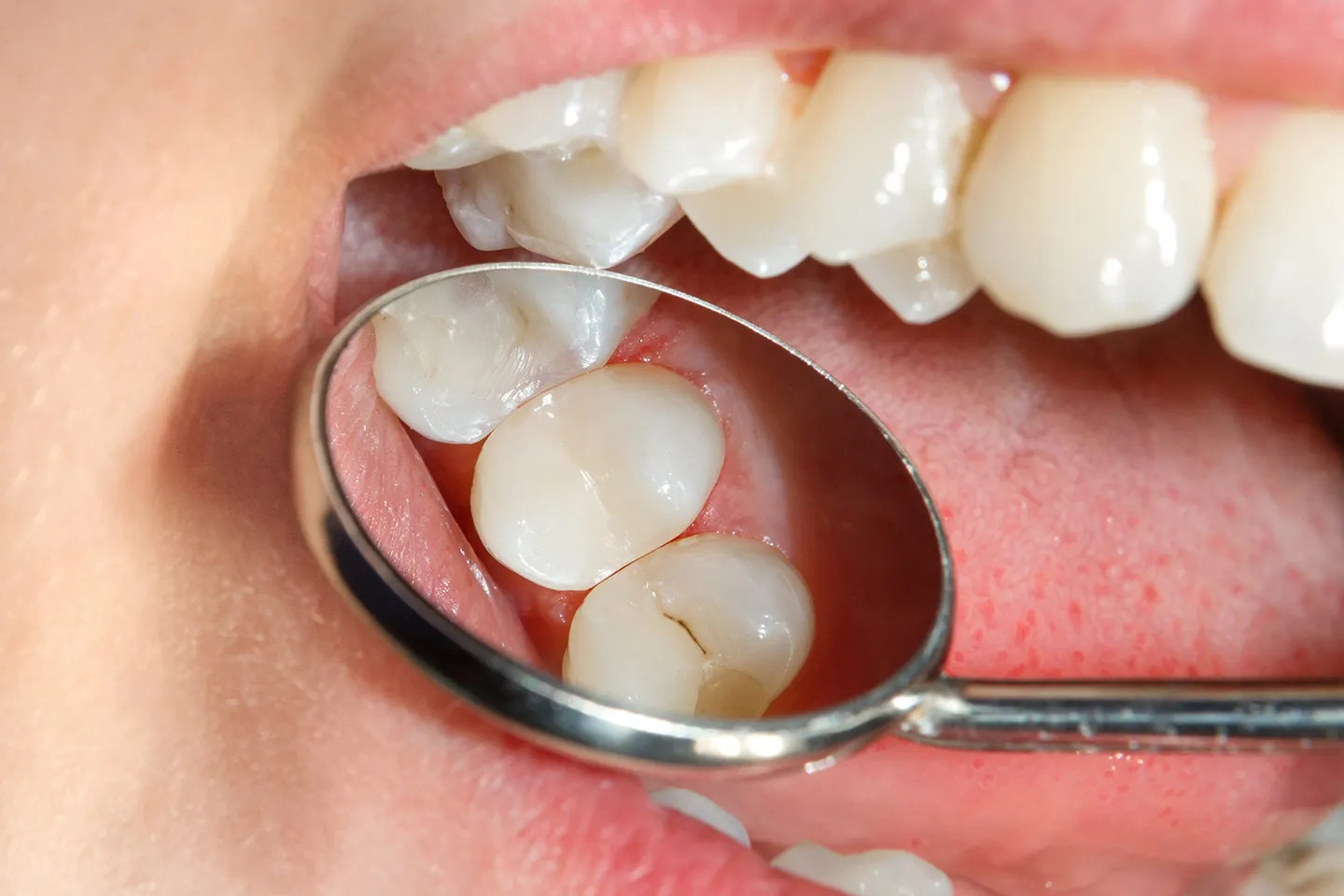 White Fillings - Dr. Sunit Jain Dental Care